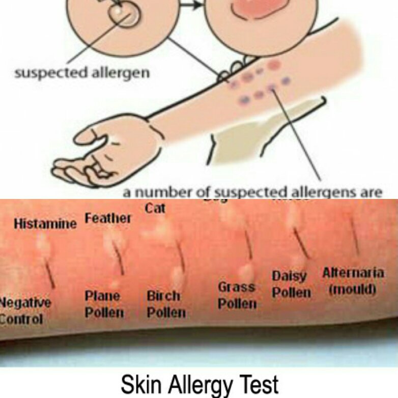 Реакция на аллергены