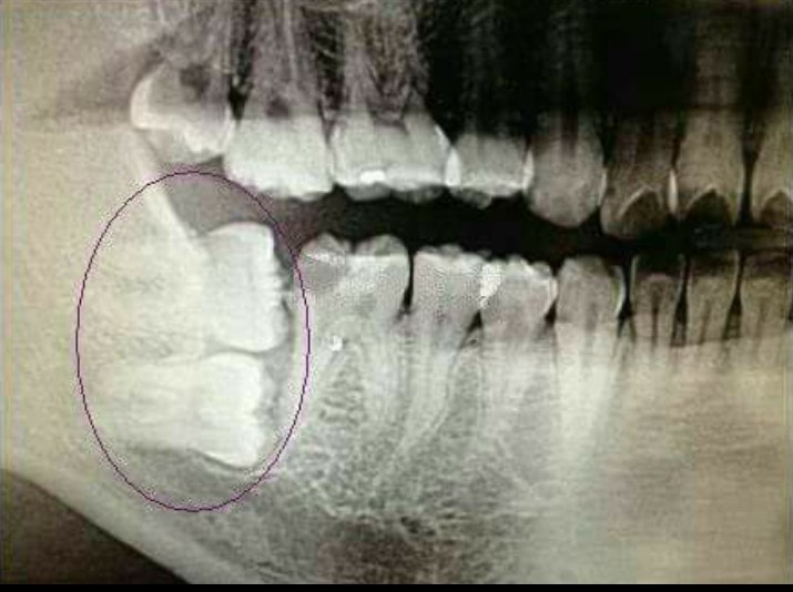 Удалить восьмерку. Ретинированный зуб снимок. Ретинированный зуб рентген. Рентген челюсти зубы мудрости. Ретинированный зуб мудрости снимок.