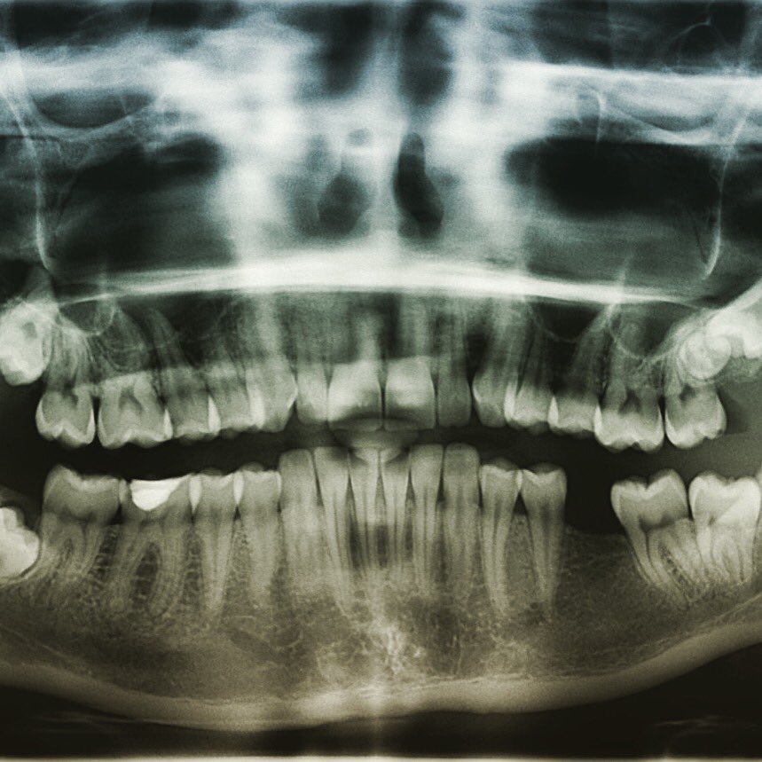 Зубы рентген фото