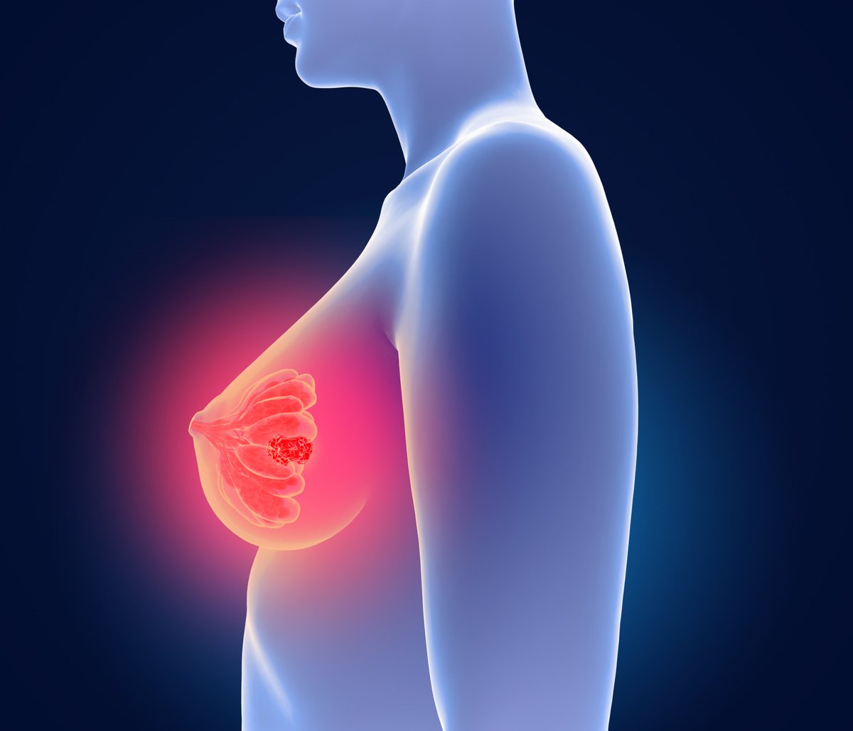 Женская грудь маммология