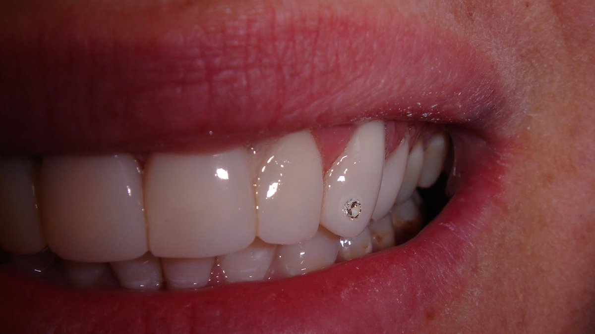 фото режущих зубов