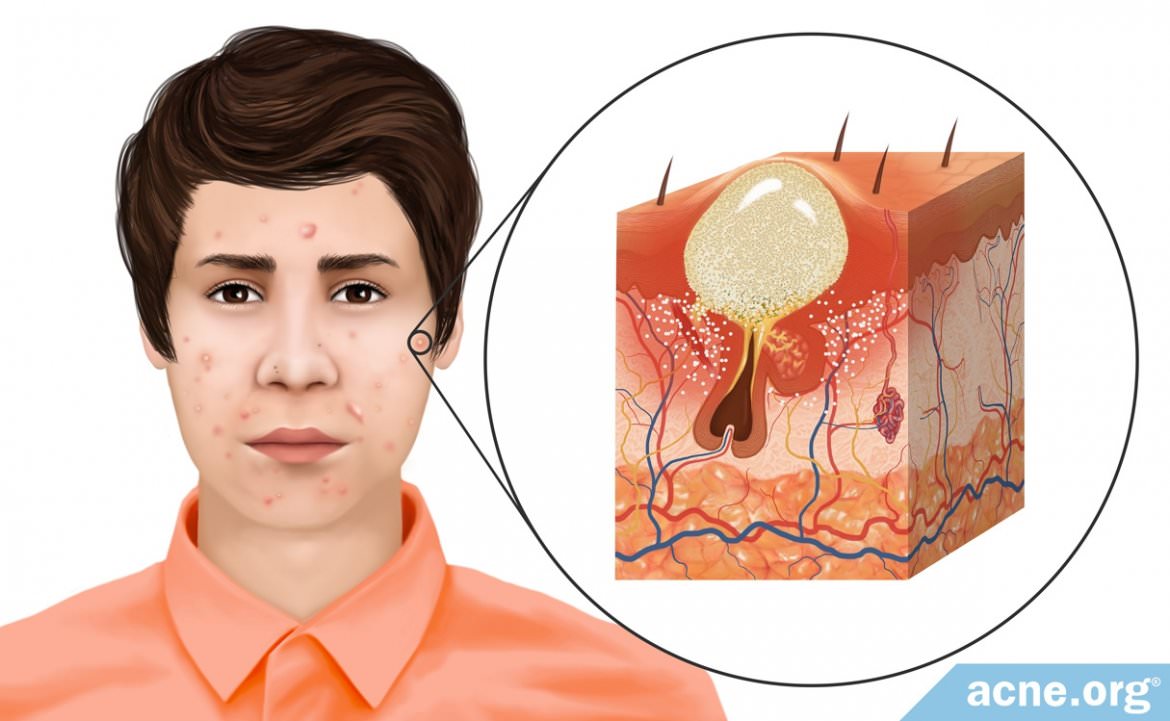 Последствия угревой сыпи на лице