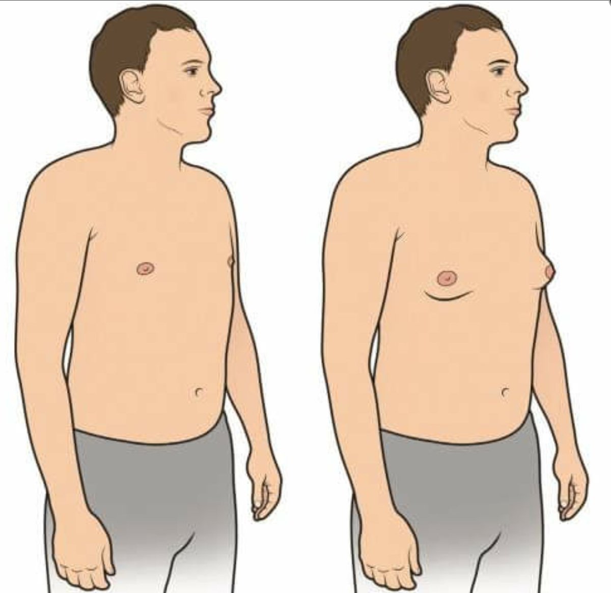 Почему у мужчин большие груди. Синдром Клайнфельтера гинекомастия. Синдром Клайнфельтера гипогонадизм. Клайнфельтер гинекомастия. Гипогонадизм гинекомастия.