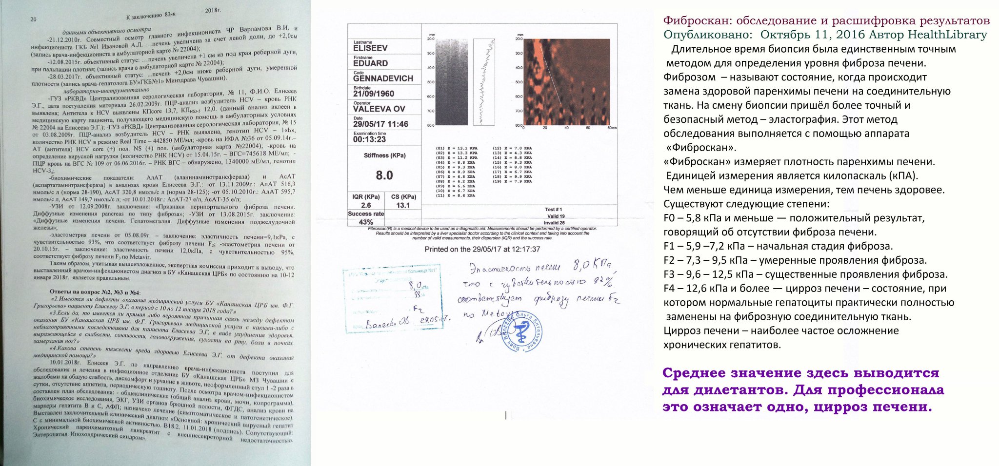 Результаты печени. Эластография печени заключение. Протокол по эластографии печени. Эластометрия расшифровка результатов. Показатели фиброскана печени.