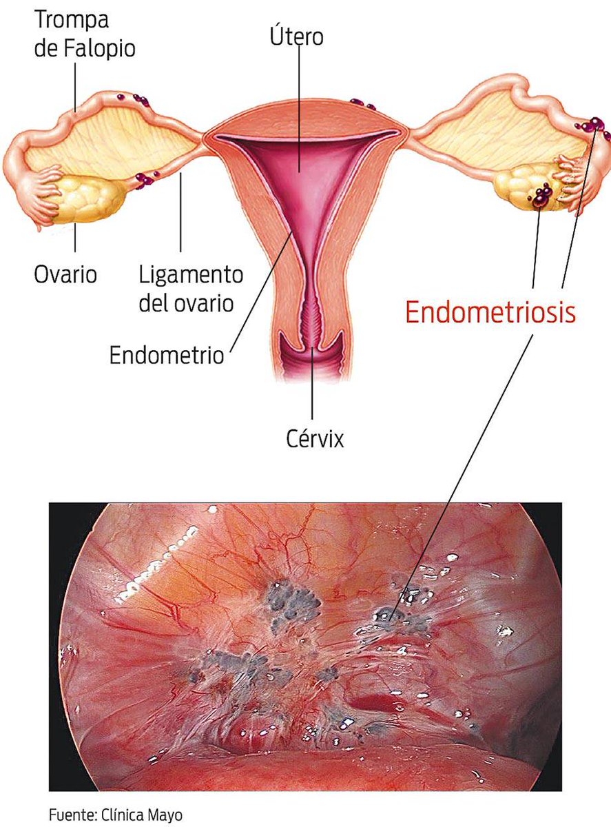 Инфильтративный эндометриоз