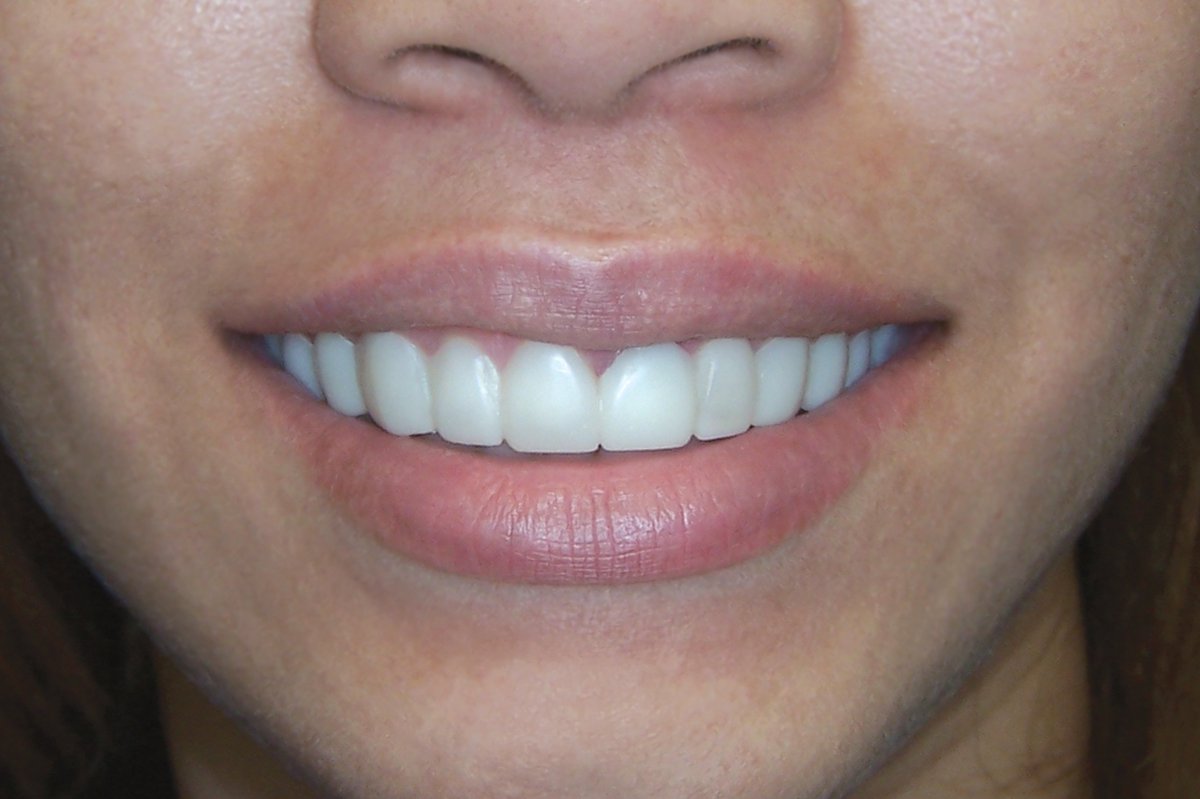 Форма нижних зубов для женщин фото