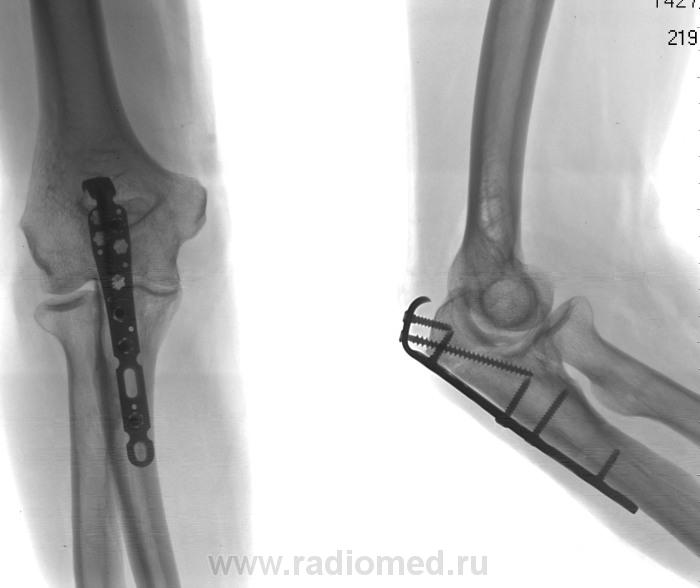 Перелом локтя со смещением. Остеосинтез локтевого отростка по Веберу рентген. Остеосинтез локтевого сустава. Перелом локтевого отростка остеосинтез. Остеосинтез перелома локтевого отростка по Веберу.