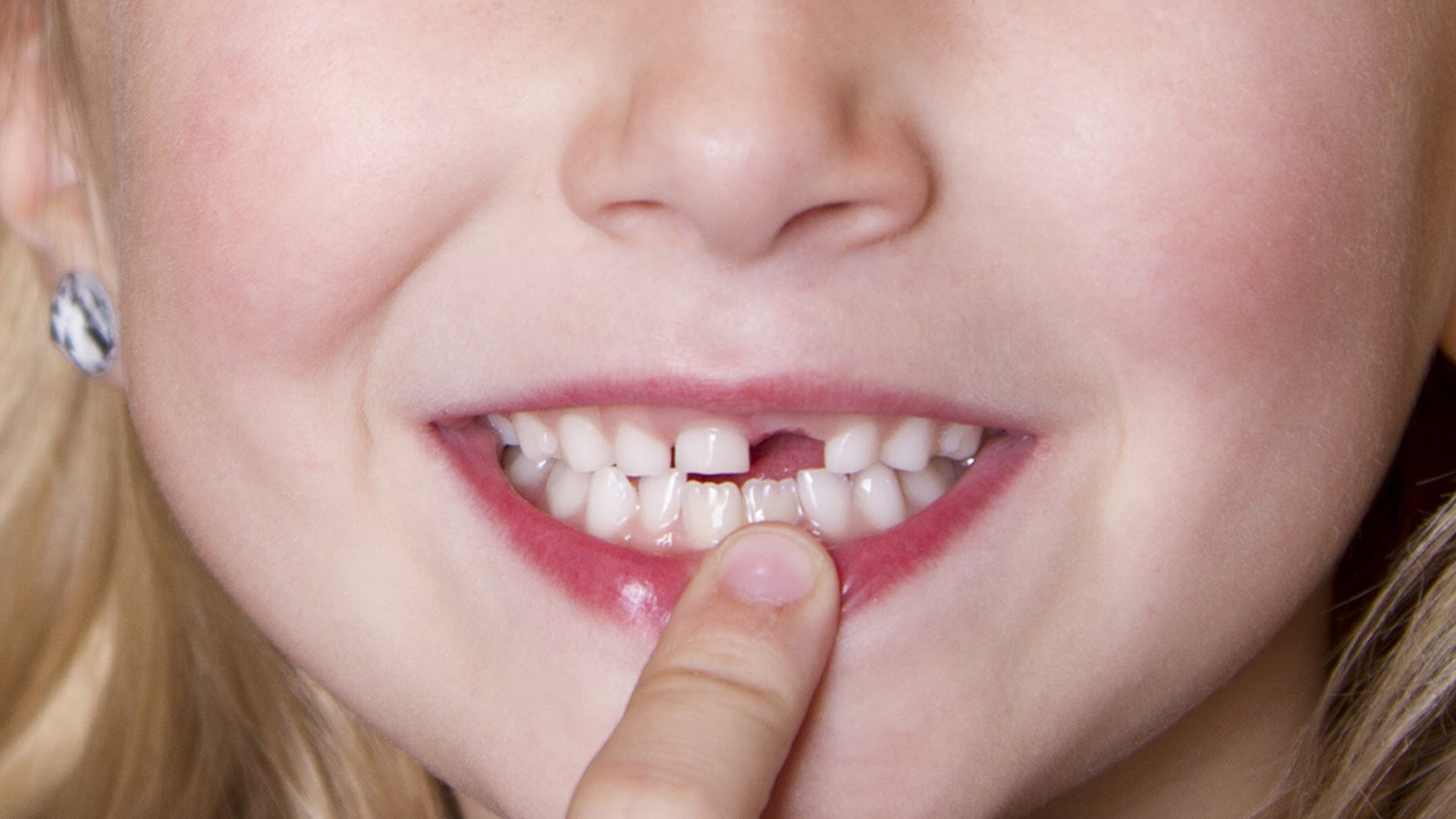 Зуб выпал без крови что значит. Вввпали передние зубы у ребенка. Передние коренные зубы.