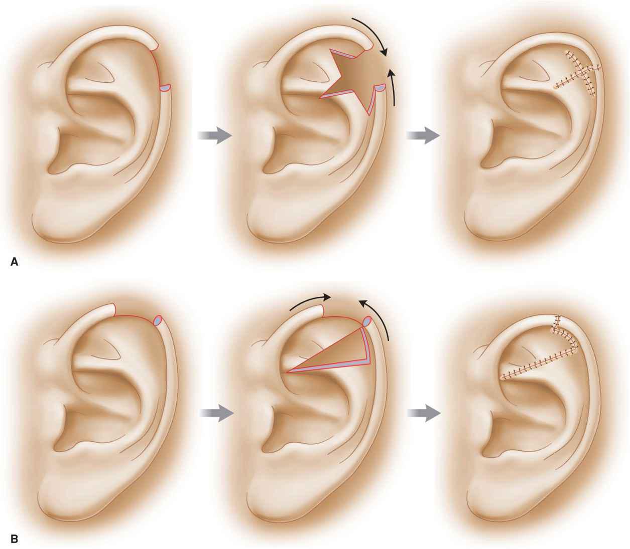 Почему уши разные. Козелок ушной раковины формы. Перихондрит ушной раковины клиника. Форма мочки ушной раковины. Отопластика (1 ушная раковина).