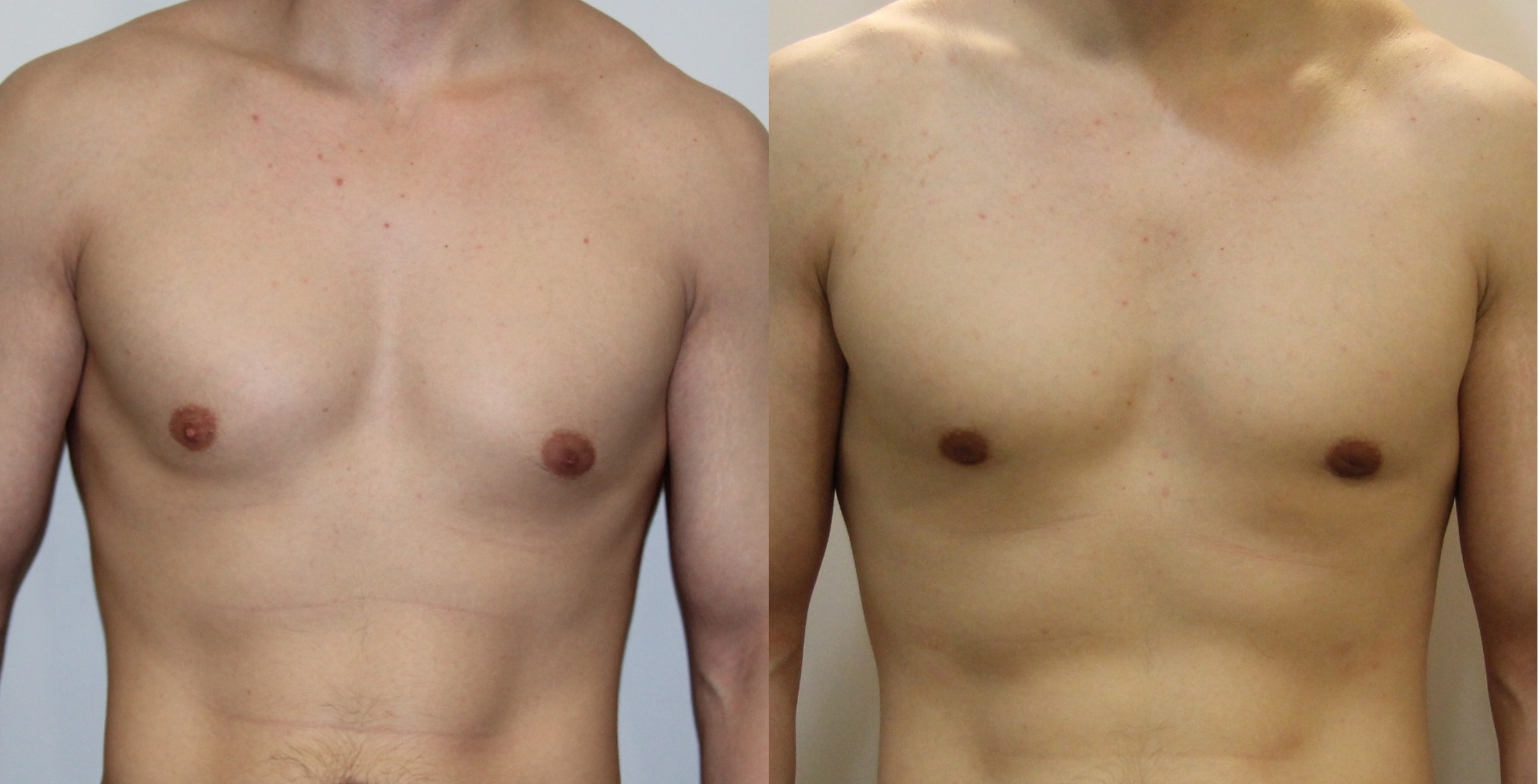 изменение груди у мужчин фото 16