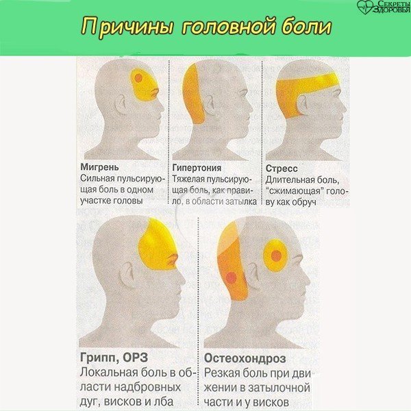 Почему головы желтые. Схема локализации головной боли. Причины головной боли.