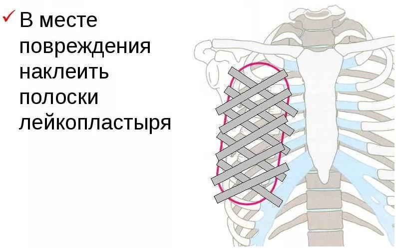 Полом ребра. Перелом ребер грудной клетки. Помощь при множественных переломах костей грудной клетки.