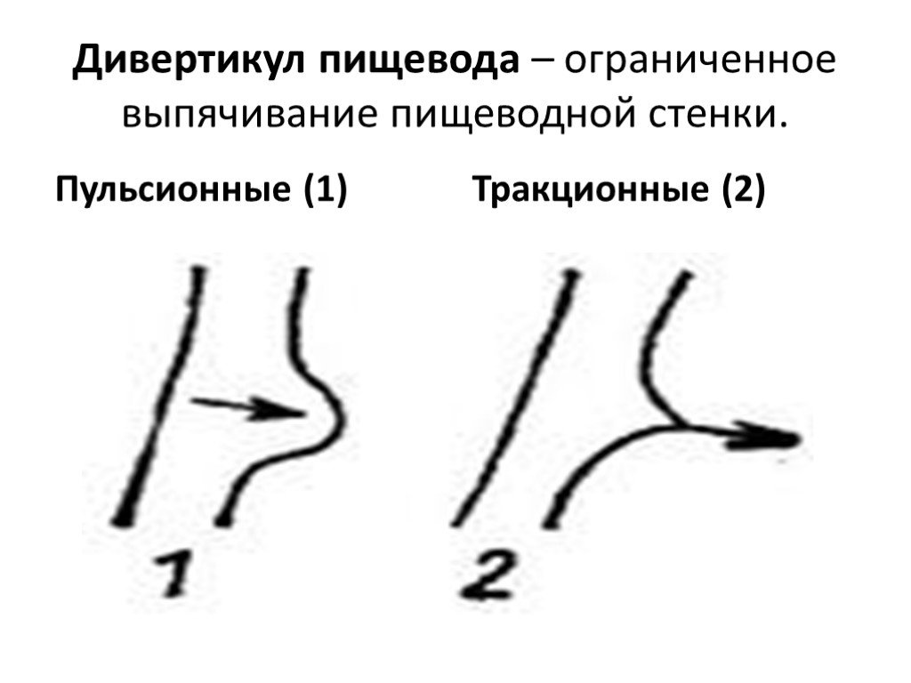 Пищевод мешок