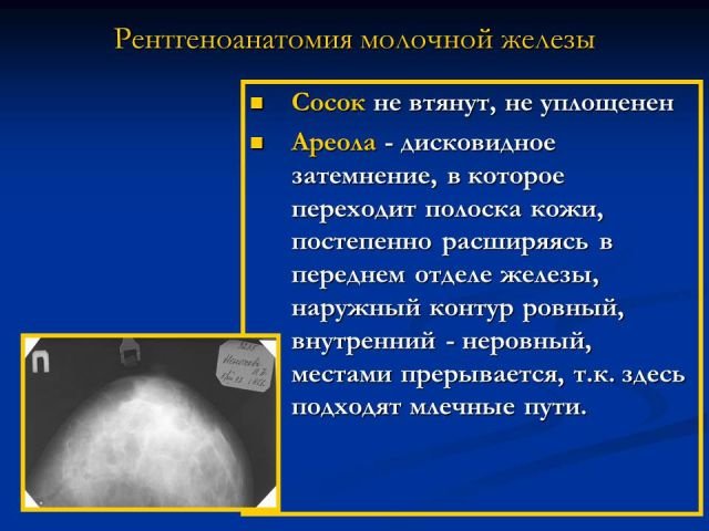 Маммография периодичность. Нормальная рентгеноанатомия молочной железы. Маммография очаговая асимметрия. Анатомия молочной железы рентген. Маммография презентация.