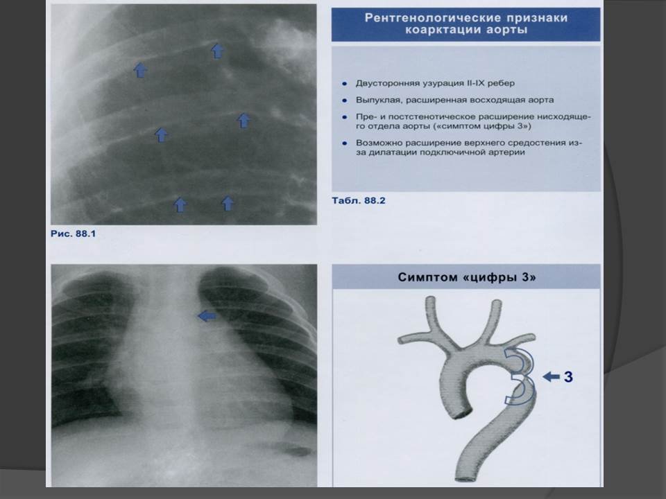 Коарктация аорты фото