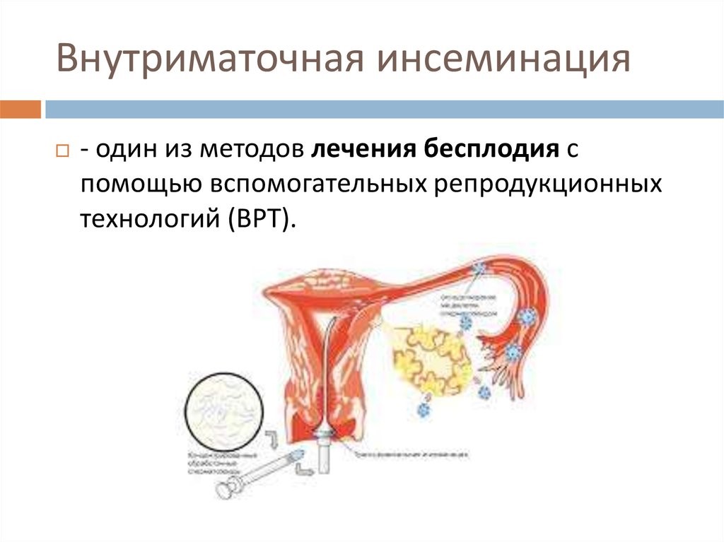 Внутриматочная инсеминация. Искусственная внутриматочная инсеминация. Внутриматочная инсеминация (ВМИ). ВМИ процедура искусственной инсеминации. Технология внутриматочной инсеминации..