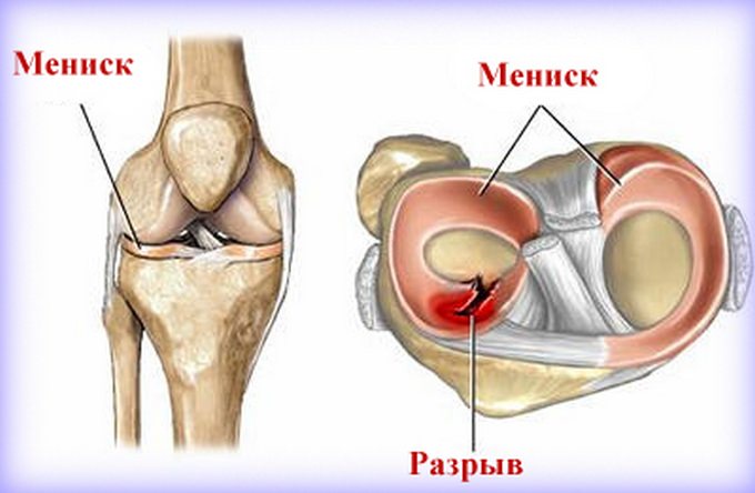 Разрыв мениска коленного сустава