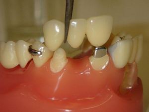 Протезирование или имплантация зубов