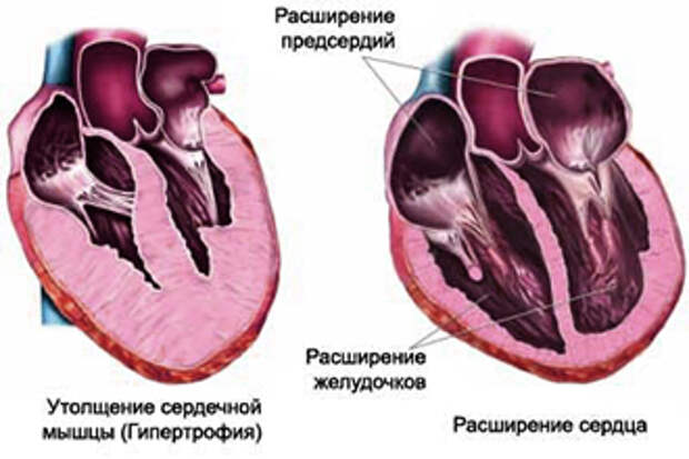 Желудочка сердца расширена. Утолщение сердечной стенки. Утолщение стенок миокарда. Утолщенная стенка в сердце.