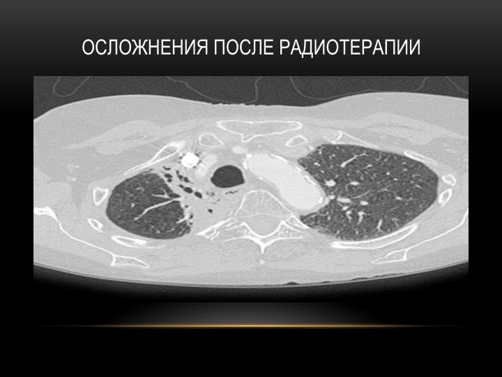 Рак брюшной. Канцероматоз кишечника. Онкология брюшной полости. Абдоминальная онкология. Онкозаболевания брюшной полости.