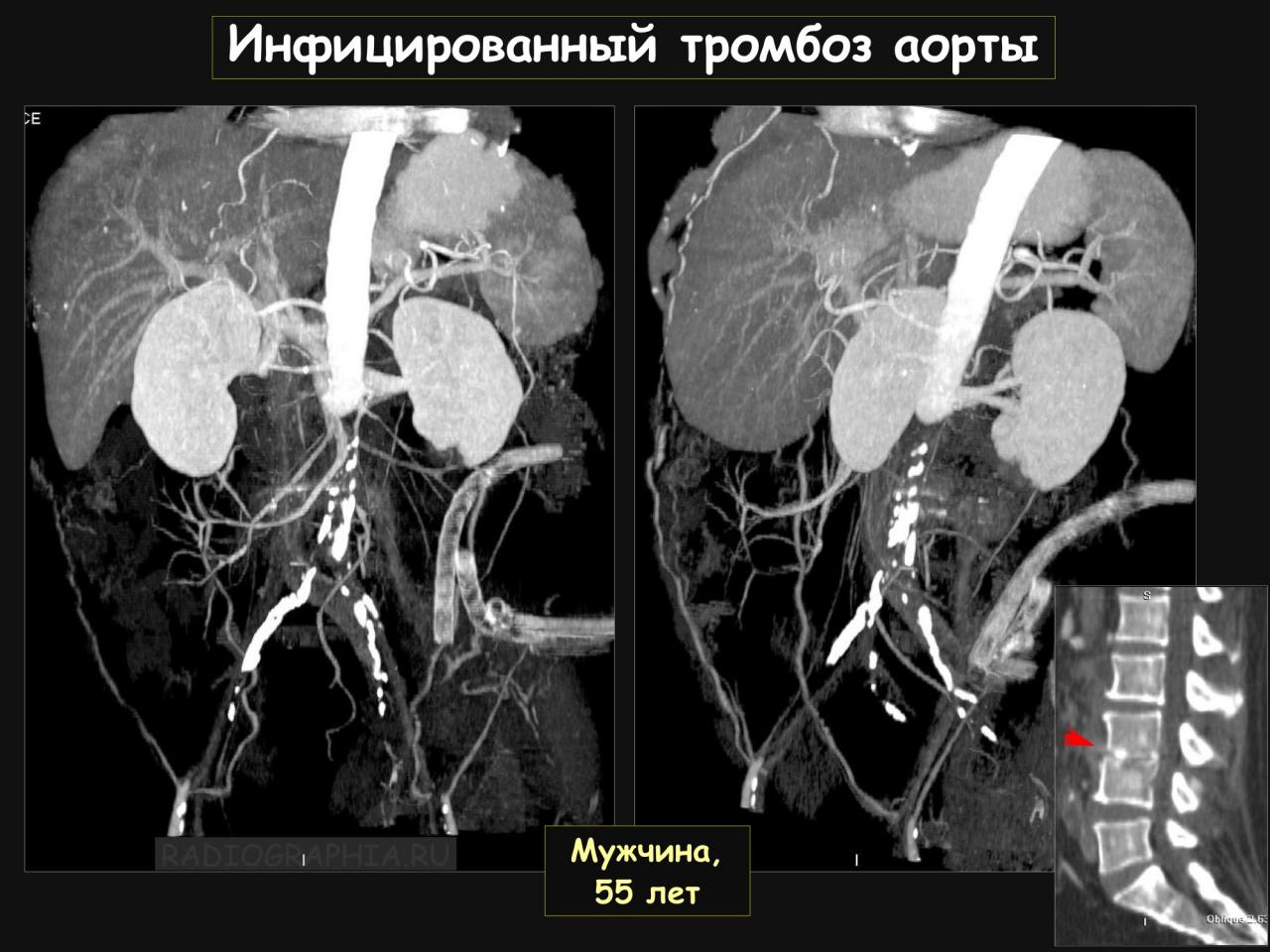 Тромбоз брюшной. Ангиография тромбоз почечной артерии. Аортография аневризма аорты. Аневризма брюшной аорты ангиография.