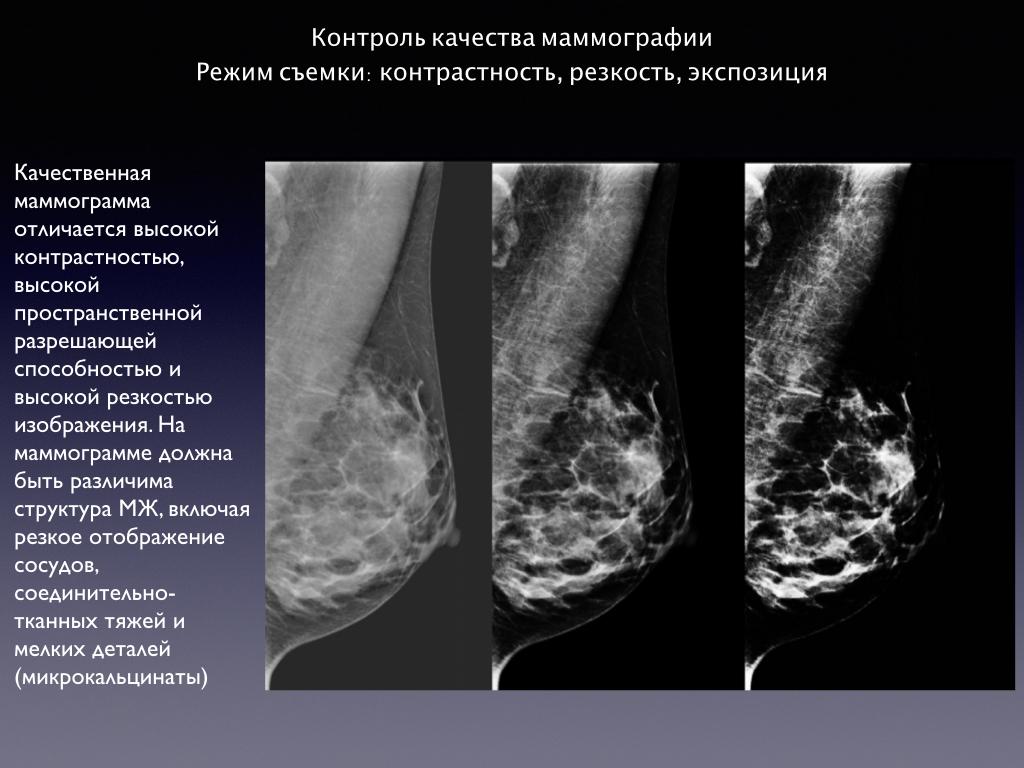 Маммография периодичность. Цифровая маммография снимки. Маммография рентген снимки. Рентгенография молочных желез. Снимки маммографии молочных желез.