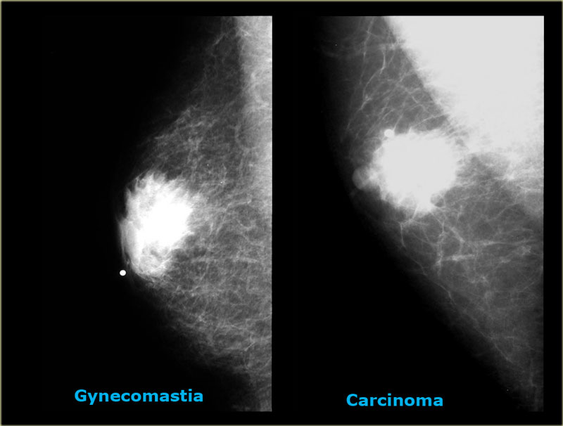 Как выглядит рак молочной железы на фото