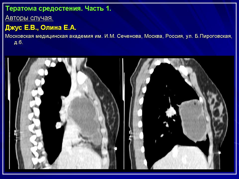 Рак средостения фото