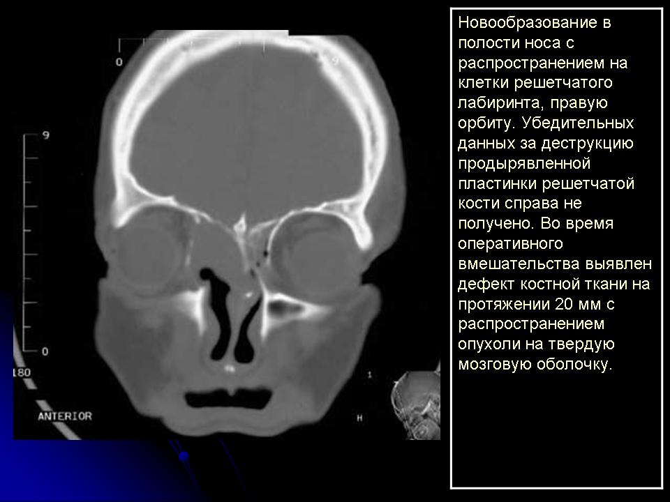 Мукоцеле носа. Мукоцеле гайморовой пазухи кт. Кт орбит и придаточных пазух носа. Мукоцеле лобной пазухи рентген. Мукоцеле лобной пазухи мрт.
