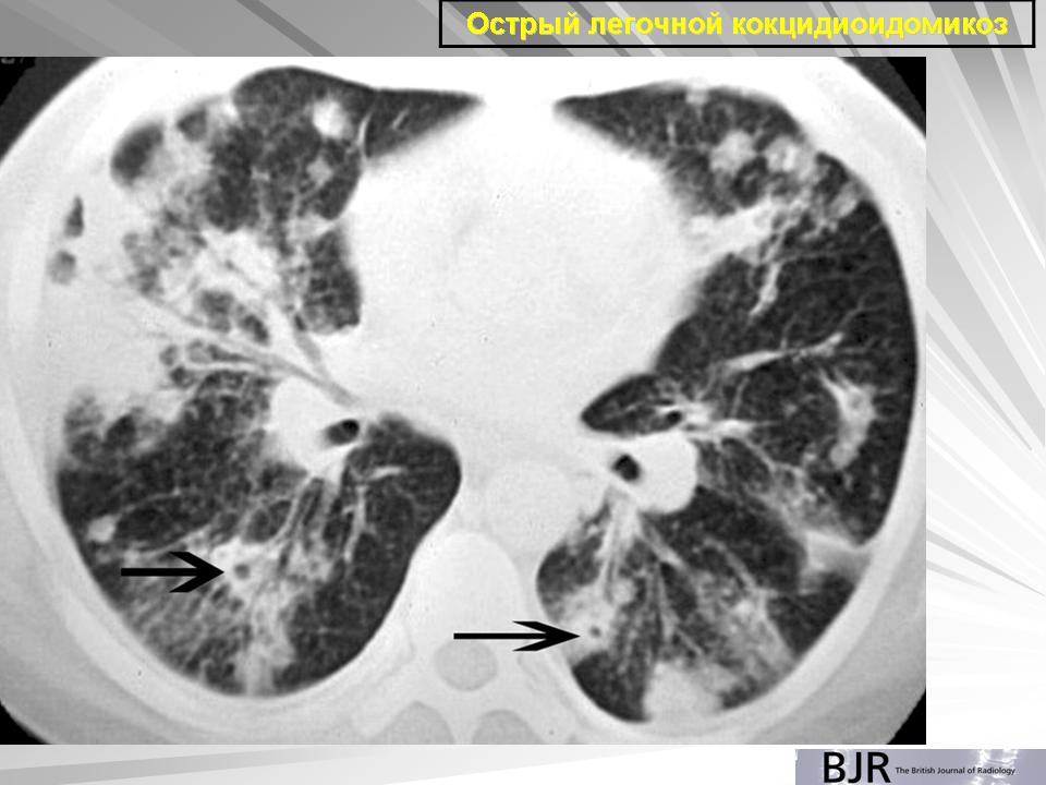 Легочная эозинофилия. Лейкозная пневмония кт. Токсоплазмоз лёгких на кт. Легочная эозинофилия на кт.