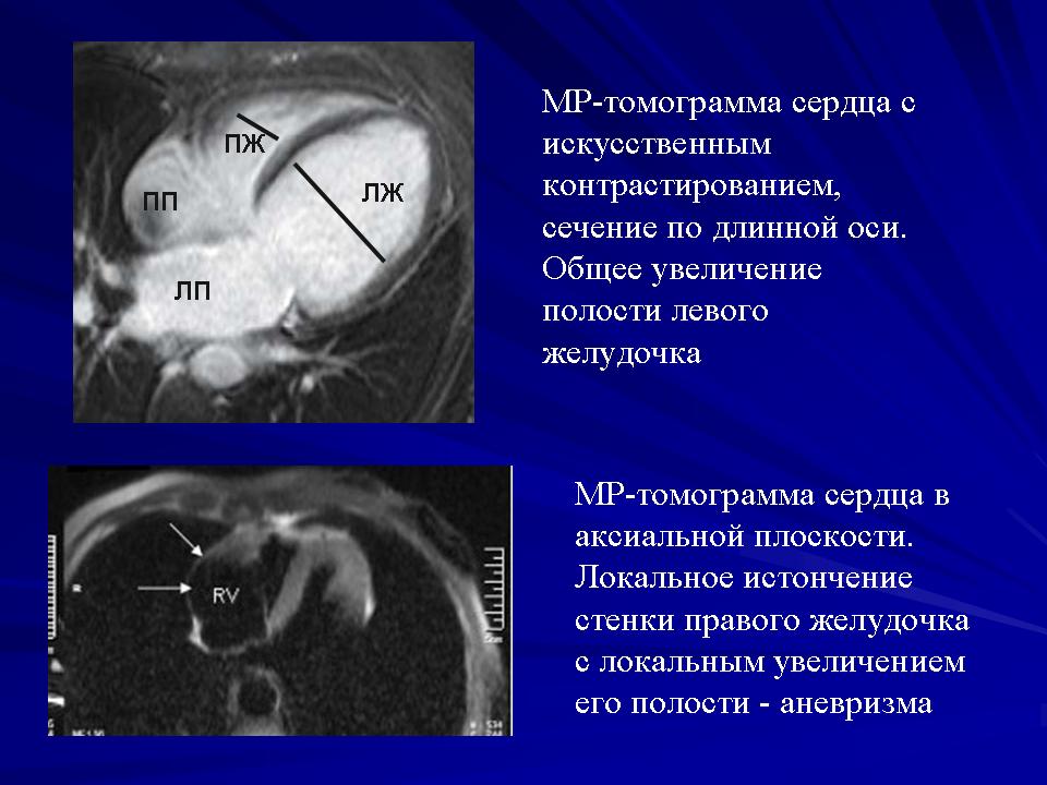 Мрт сердца