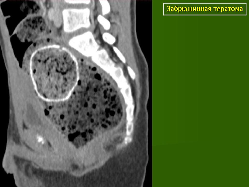 Узи забрюшинных. Забрюшинная тератома кт. Тератома брюшной полости. Тератома забрюшинного пространства.