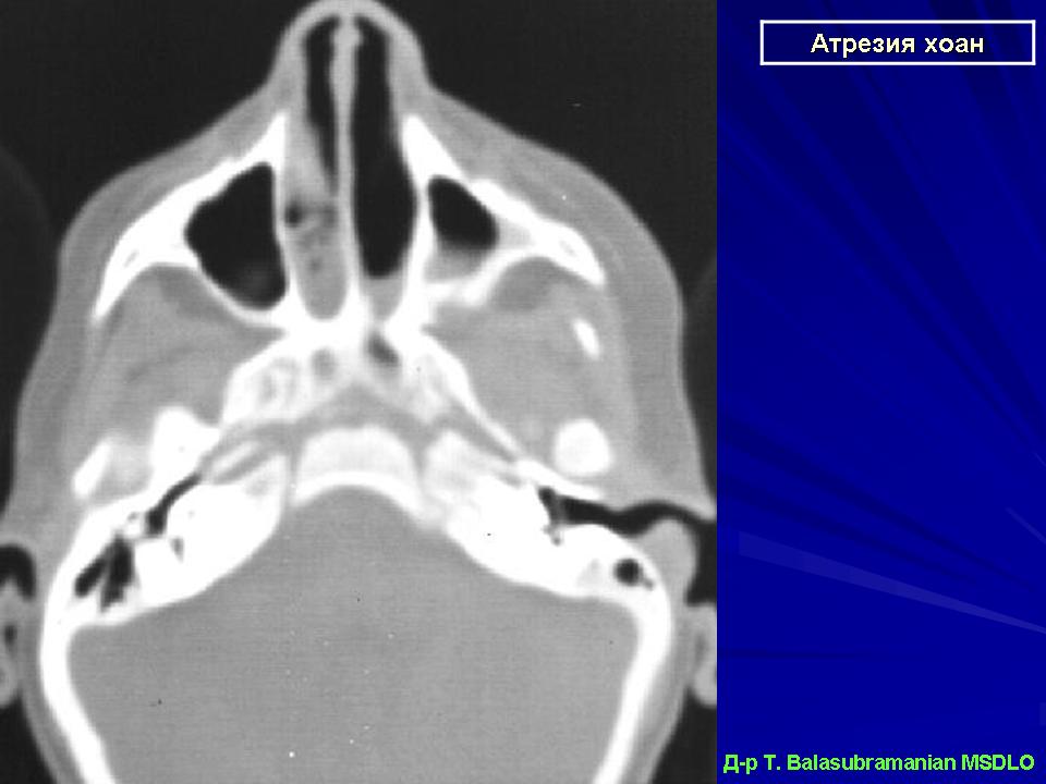 Атрезия хоан презентация