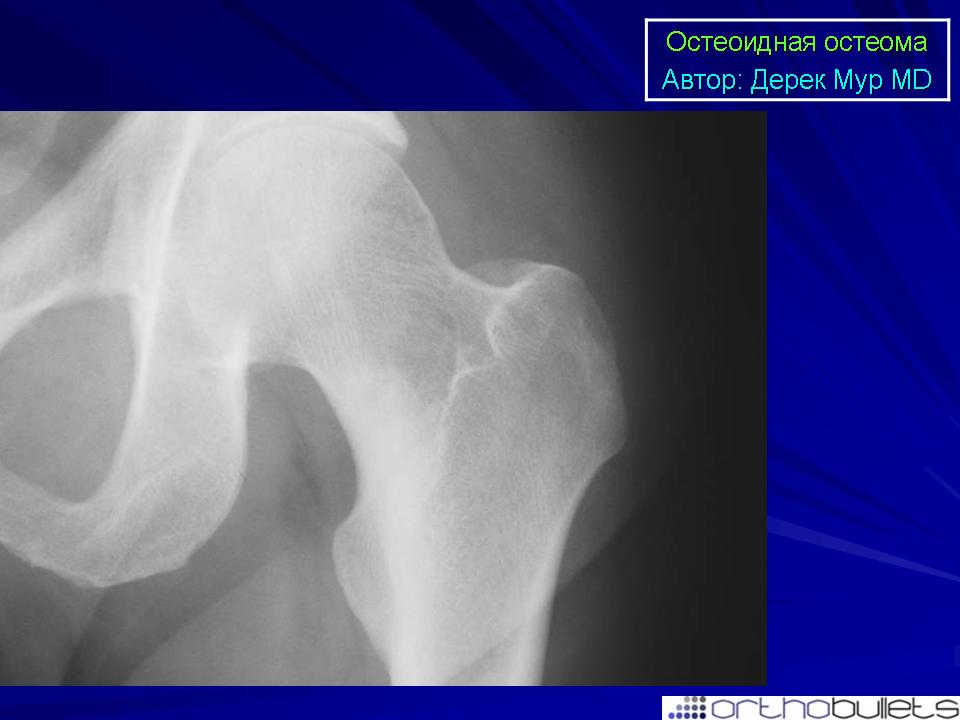 Остеоид остеома бедренной кости. Остеома седалищной кости рентген. Юкстакортикальная остеоид остеома.