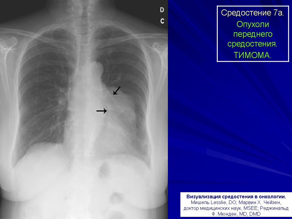 Рак средостения симптомы фото