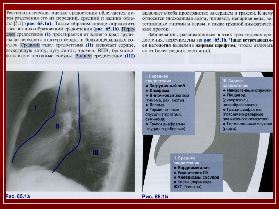 Рак средостения симптомы фото