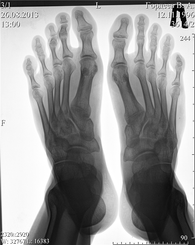 Рентген стопы фото. Поперечное плоскостопие рентген. Поперечное плоскостопие рентген снимок. Поперечное плоскостопие на рентгенограмме. Сесамоидит 1 пальца стопы рентген.