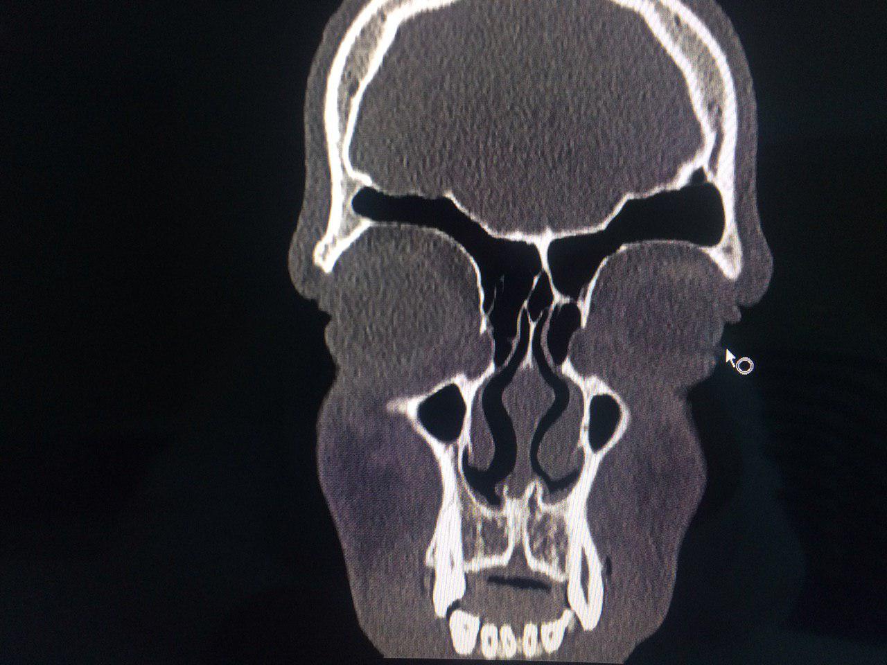 Кт придаточных пазух. Остеохондрома лобной пазухи кт. Кт придаточных пазух остеома.