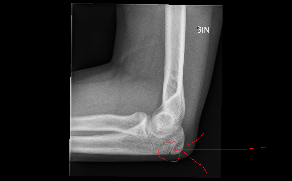 Перелом смещение локтя. Локтевой сустав рентген норма. Синовит локтевого сустава рентген. Перелом локтевого сустава рентген. Трещина в локтевом суставе рентген.
