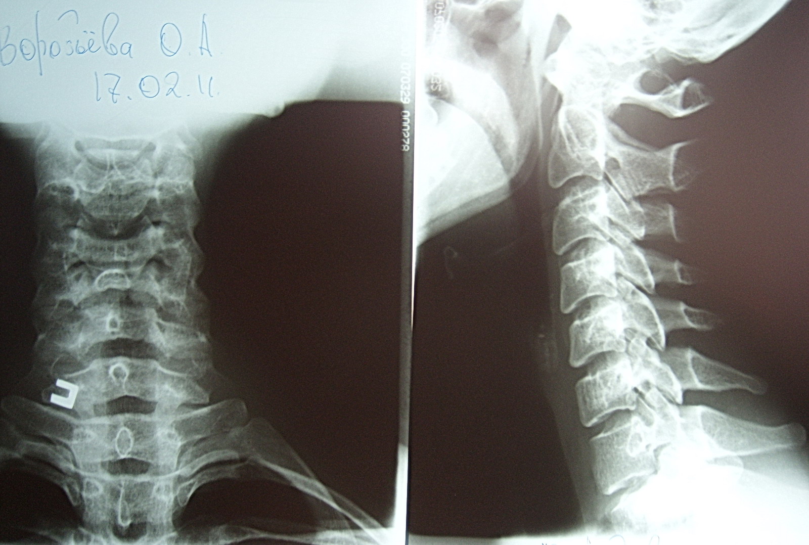 Рентген шейного отдела фото