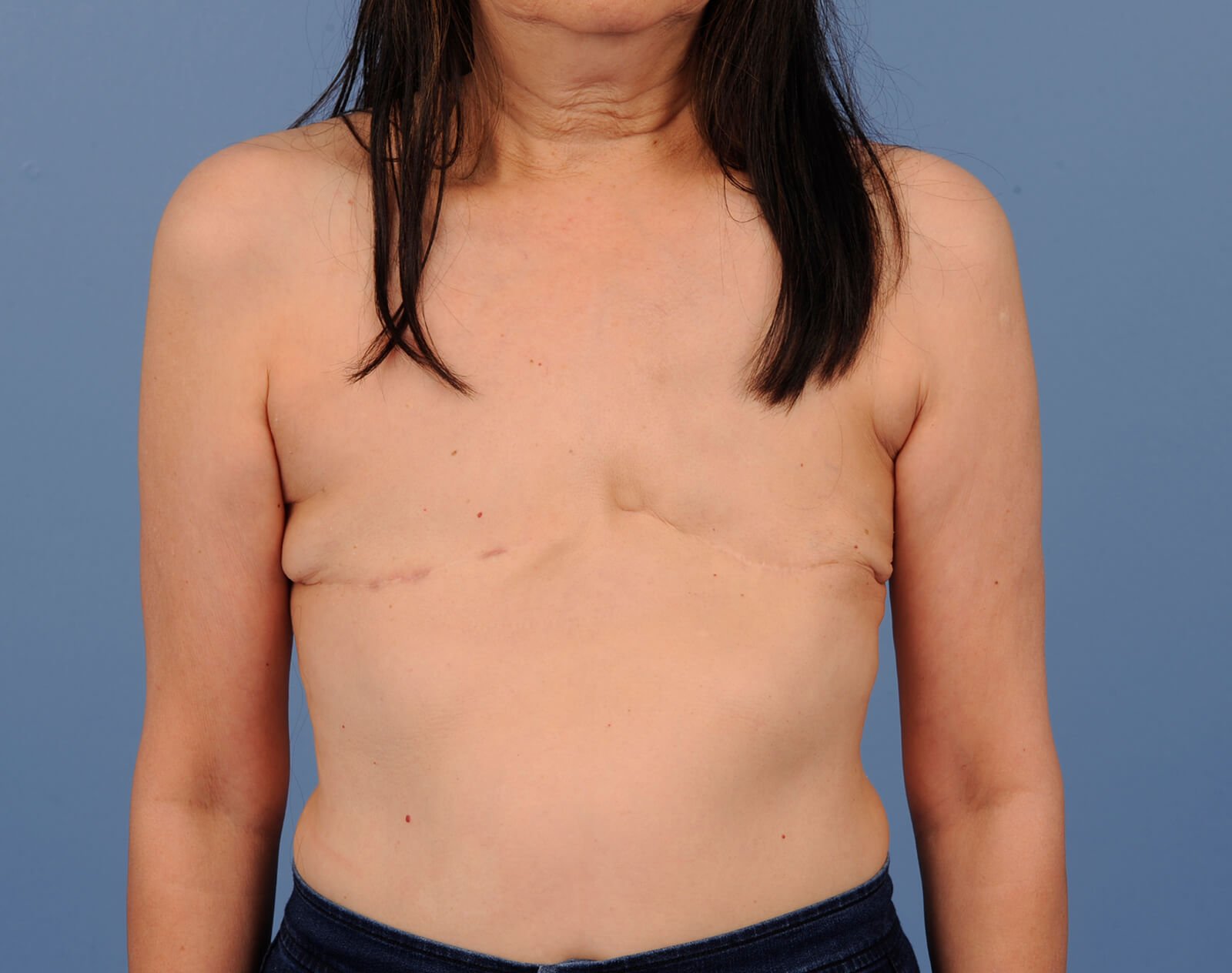 операция на груди у женщин фото 16