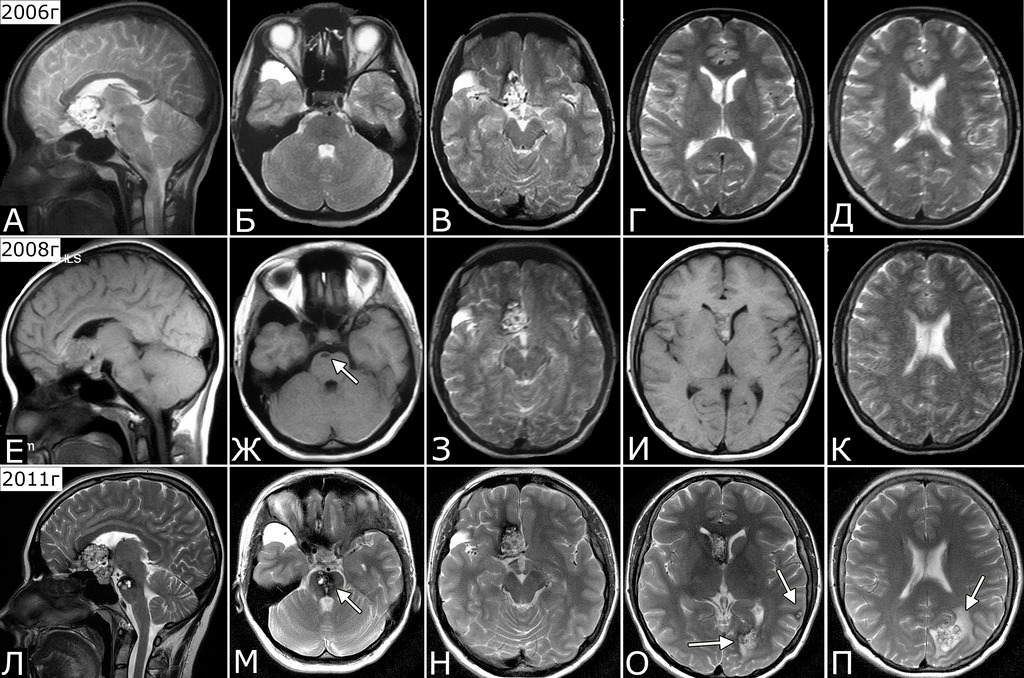 Контрастное мрт мозга. Мрт мозга сбоку. Мрт головного мозга Axial норма. Компьютерная томография головного мозга норма.