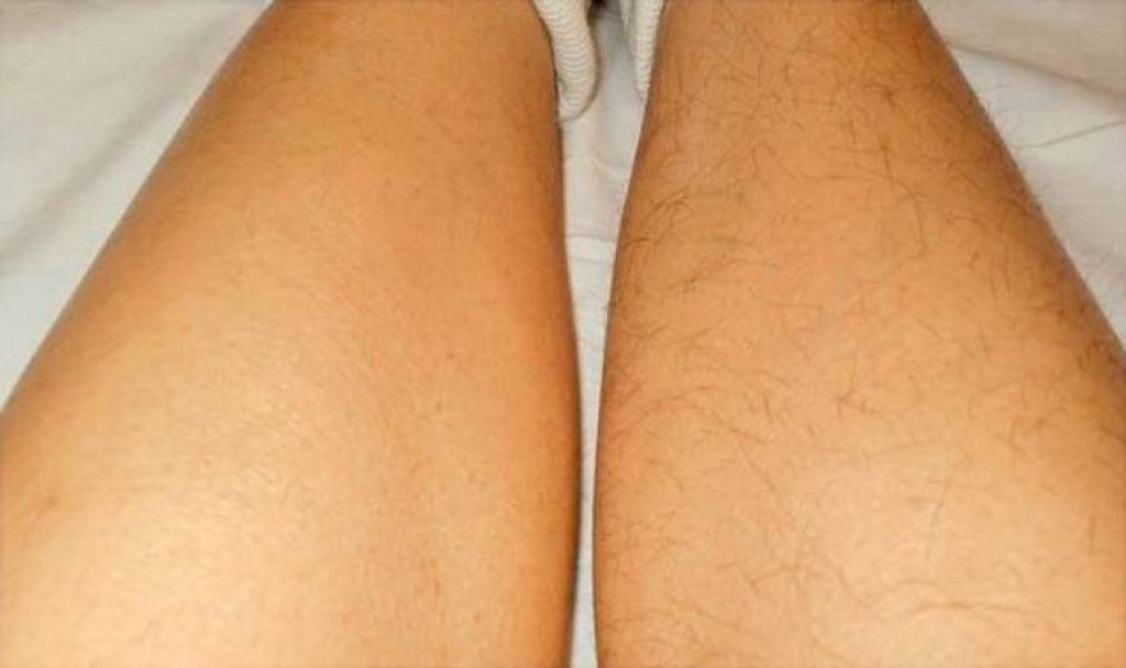 Депиляция ног и голени