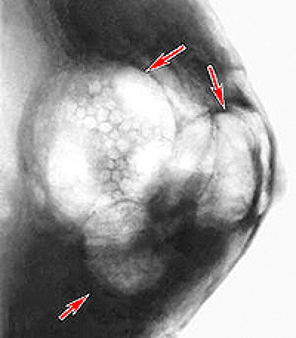 может ли болеть только одна грудь при фиброзно кистозной мастопатии фото 38