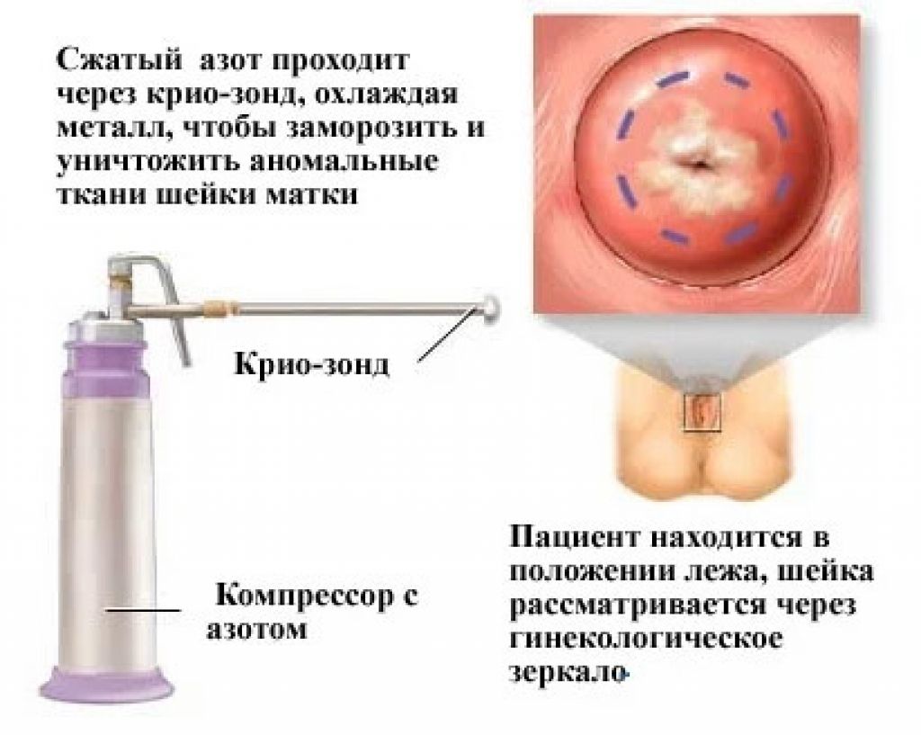 Лечение шейки. Криодеструкция эрозии шейки матки. Криодеструкция эктопии шейки матки. Заморозка азотом шейки матки. Шейка матки конической формы.