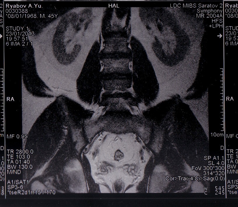 Мрт крестцового отдела. Мрт снимок. Снимок пояснично-крестцового отдела мрт белое. Мрт крестцово поясничного Ульяновск. C 53.1 на мрт.