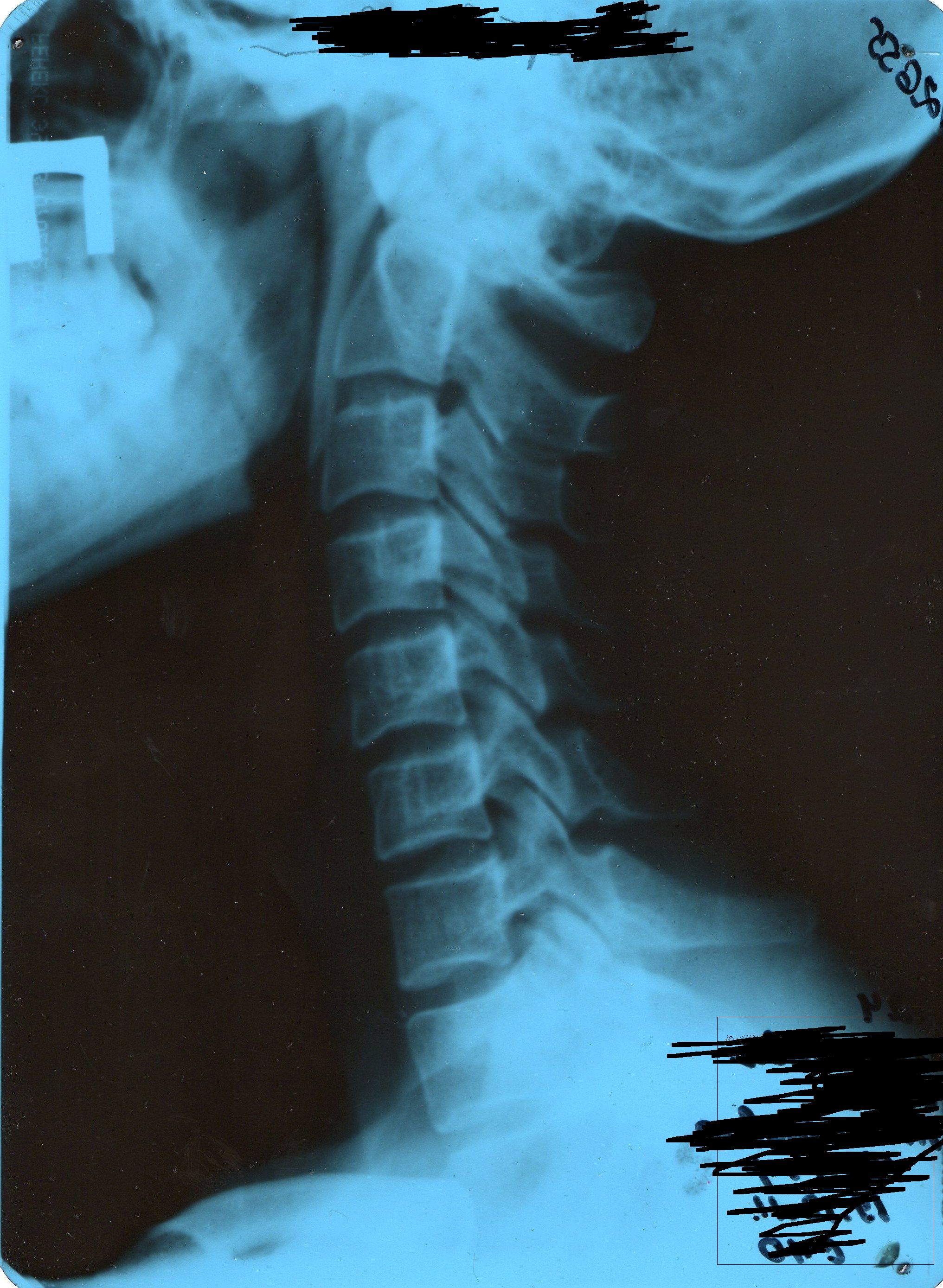 Рентген шейного. Рентген шейного отдела позвоночника. Сколиоз шейного отдела позвоночника рентген. Гиполордоз шейного отдела. Рентген шейного отдела позвоночника остеохондроз.
