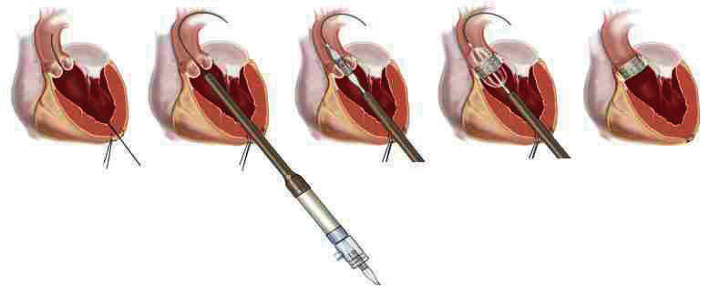 Пластика клапанов. Транскатетерная имплантация аортального клапана. Имплантация митрального клапана. Транскатетерная имплантация митрального клапана. Эндоваскулярное протезирование аортального клапана.