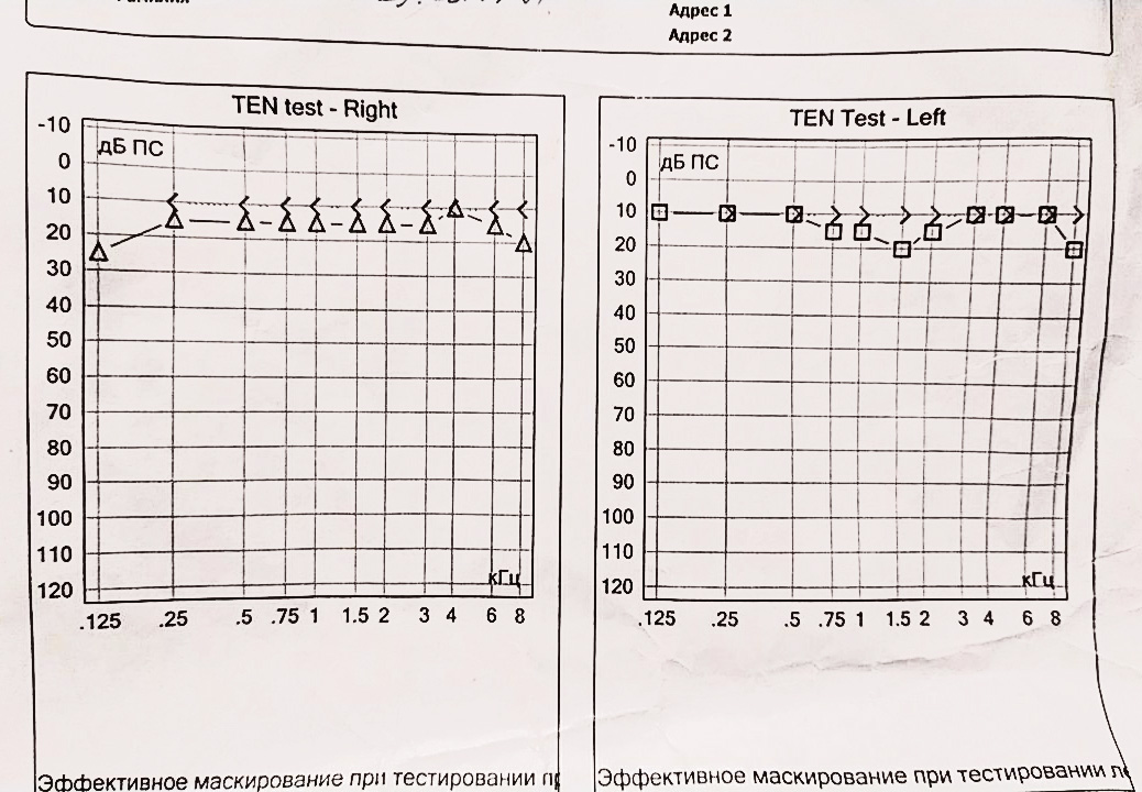 Тональная пороговая аудиометрия