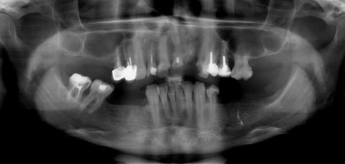 Частичный случай. Ортопантомограмма адентия. ОПТГ С частичным отсутствием зубов.
